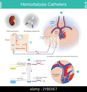 Cathéters d'hémodialyse. Un cathéter de dialyse est un cathéter utilisé pour échanger du sang du cœur vers et depuis une machine d'hémodialyse et un patient. Banque D'Images