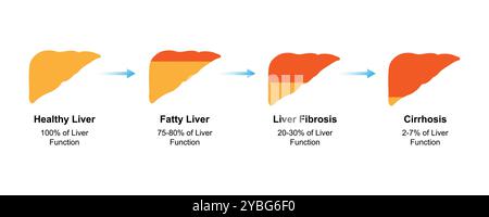Stades de la maladie du foie, illustration. Banque D'Images