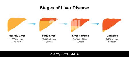 Stades de la maladie du foie, illustration. Banque D'Images