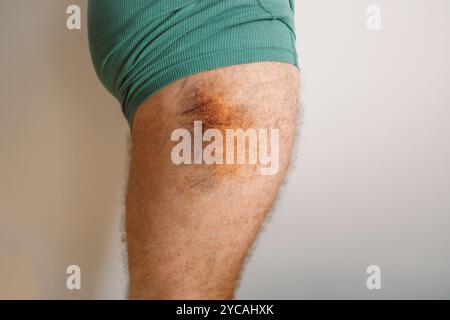 Blessure à la cuisse résultant d'une collision, d'un impact ou d'une chute, blessure à la jambe d'un homme. Blessure. Énorme contusion jaune-bleu avec une abrasion sur la cuisse Banque D'Images