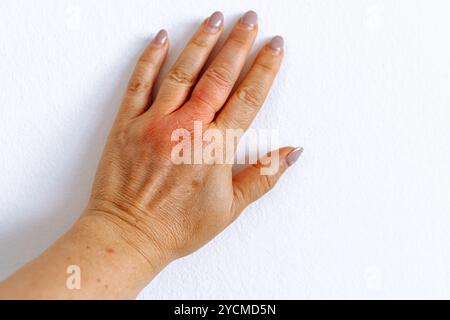 main féminine avec des taches pigmentaires sur la peau, doigt gonflé par piqûre d'insecte Banque D'Images