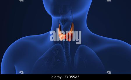 Propagation tumorale dans la glande thyroïde Banque D'Images