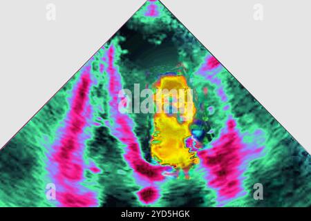 Insuffisance mitrale ischémique (IM) - pathologie du ventricule gauche (anneau mitral et appareil sous-valvulaire). L'échocardiographie transthoracique (TTE). Banque D'Images