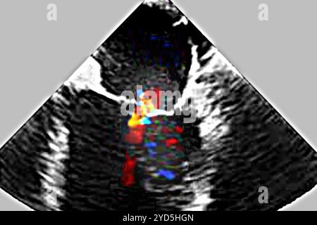 Insuffisance mitrale ischémique (IM) - pathologie du ventricule gauche (anneau mitral et appareil sous-valvulaire). L'échocardiographie transthoracique (TTE). Banque D'Images