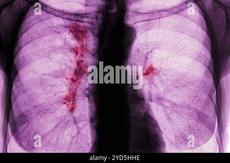 Cancer du poumon droit et gauche (stade 1). Radiographie du thorax avant. Banque D'Images