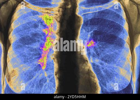 Cancer du poumon droit et gauche (stade 1). Radiographie du thorax avant. Banque D'Images