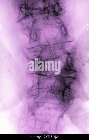 Ostéoporose lombaire (maladie causant compression et fractures des vertèbres lombaires). Radiographie des vertèbres lombaires vue de face. Banque D'Images