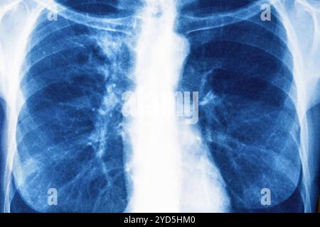 Cancer du poumon droit et gauche (stade 1). Radiographie du thorax avant. Banque D'Images