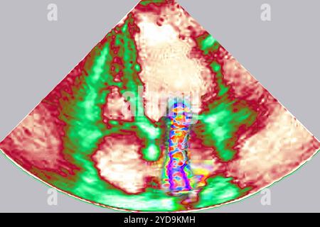 Insuffisance mitrale ischémique IM - pathologie de l'anneau mitral du ventricule gauche et de l'appareil sous-valvulaire. Echocardiographie transthoracique TTE. Insuffisance mitrale 016836 021 Banque D'Images