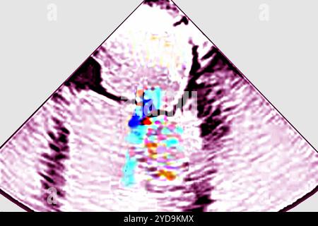 Insuffisance mitrale ischémique IM - pathologie de l'anneau mitral du ventricule gauche et de l'appareil sous-valvulaire. Echocardiographie transthoracique TTE. Insuffisance mitrale 016836 023 Banque D'Images