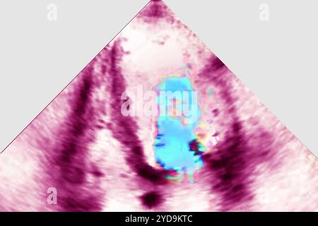 Insuffisance mitrale ischémique IM - pathologie de l'anneau mitral du ventricule gauche et de l'appareil sous-valvulaire. Echocardiographie transthoracique TTE. Insuffisance mitrale 016836 047 Banque D'Images
