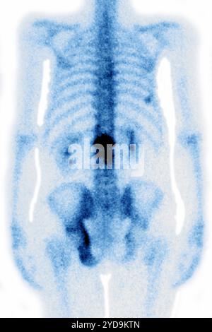 Ostéoporose lombaire provoquant compression et fractures des vertèbres lombaires. Radiographie des vertèbres lombaires vue de face. Ostéoporose lombaire. 016836 037 Banque D'Images