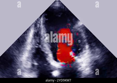 Insuffisance mitrale ischémique IM - pathologie de l'anneau mitral du ventricule gauche et de l'appareil sous-valvulaire. Echocardiographie transthoracique TTE. Insuffisance mitrale 016836 046 Banque D'Images