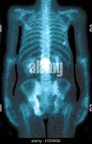 Ostéoporose lombaire provoquant compression et fractures des vertèbres lombaires. Radiographie des vertèbres lombaires vue de face. Ostéoporose lombaire. 016836 038 Banque D'Images