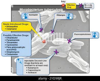 La tuberculose XDR survient lorsqu'une souche de Mycobacterium tuberculosis est résistante à l'isoniazide et à la rifampicine, deux des médicaments de première intention les plus puissants, ainsi qu'aux médicaments clés du schéma thérapeutique de deuxième intention, toute fluoroquinolone et au moins un des trois médicaments injectables indiqués ci-dessus. Les souches de tuberculose XDR peuvent également être résistantes à d'autres médicaments, ce qui complique grandement le traitement. Tuberculose ultrarésistante tuberculose ultrarésistante - Options de traitement 016867 194 Banque D'Images