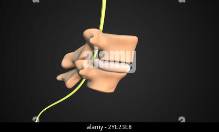 Glissement vertébral entraînant des symptômes spondylolisthésiques Banque D'Images