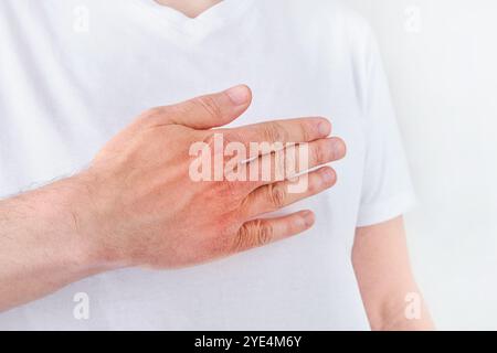 Homme gratte ou montre les mains avec la peau sèche et fissurée sur fond blanc. Problème avec beaucoup de gens - eczéma sur la main, allergies ou peau sèche. Voiture de santé Banque D'Images