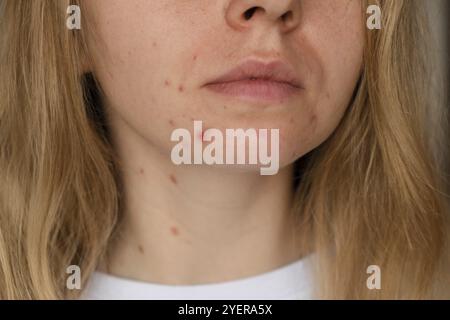 Femme méconnaissable montrant son acné sur le visage. Gros plan acné sur le visage de la femme avec éruption cutanée, cicatrice et tache allergique aux cosmétiques. Problème skincar Banque D'Images