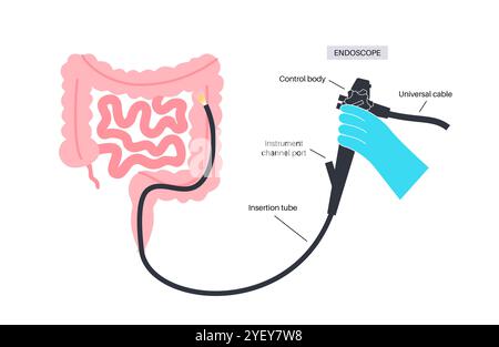 Illustration conceptuelle d'un procédé de coloscopie. Il s'agit d'un examen de l'intérieur de votre gros intestin, qui comprend le côlon, le rectum et l'anus. Il peut être utilisé pour explorer les causes possibles des douleurs abdominales, des saignements rectaux, des diarrhées chroniques et d'autres problèmes gastro-intestinaux. Il est également utilisé pour rechercher des signes possibles de cancer colorectal ou de polypes. Banque D'Images