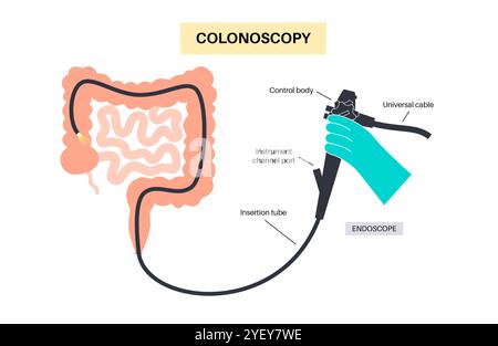 Illustration conceptuelle d'un procédé de coloscopie. Il s'agit d'un examen de l'intérieur de votre gros intestin, qui comprend le côlon, le rectum et l'anus. Il peut être utilisé pour explorer les causes possibles des douleurs abdominales, des saignements rectaux, des diarrhées chroniques et d'autres problèmes gastro-intestinaux. Il est également utilisé pour rechercher des signes possibles de cancer colorectal ou de polypes. Banque D'Images