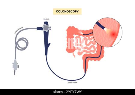 Illustration conceptuelle d'un procédé de coloscopie. Il s'agit d'un examen de l'intérieur de votre gros intestin, qui comprend le côlon, le rectum et l'anus. Il peut être utilisé pour explorer les causes possibles des douleurs abdominales, des saignements rectaux, des diarrhées chroniques et d'autres problèmes gastro-intestinaux. Il est également utilisé pour rechercher des signes possibles de cancer colorectal ou de polypes. Banque D'Images