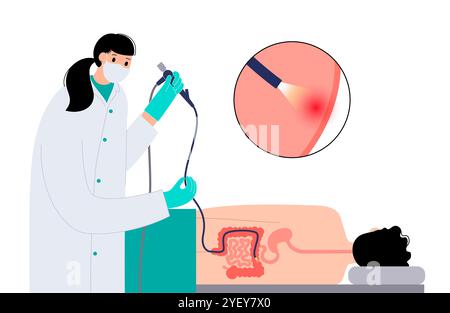 Illustration conceptuelle d'un procédé de coloscopie. Il s'agit d'un examen de l'intérieur de votre gros intestin, qui comprend le côlon, le rectum et l'anus. Il peut être utilisé pour explorer les causes possibles des douleurs abdominales, des saignements rectaux, des diarrhées chroniques et d'autres problèmes gastro-intestinaux. Il est également utilisé pour rechercher des signes possibles de cancer colorectal ou de polypes. Banque D'Images