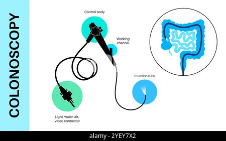 Illustration conceptuelle d'un procédé de coloscopie. Il s'agit d'un examen de l'intérieur de votre gros intestin, qui comprend le côlon, le rectum et l'anus. Il peut être utilisé pour explorer les causes possibles des douleurs abdominales, des saignements rectaux, des diarrhées chroniques et d'autres problèmes gastro-intestinaux. Il est également utilisé pour rechercher des signes possibles de cancer colorectal ou de polypes. Banque D'Images