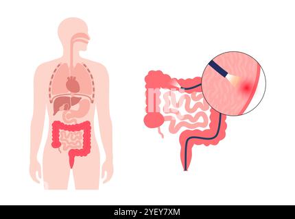 Illustration conceptuelle d'un procédé de coloscopie. Il s'agit d'un examen de l'intérieur de votre gros intestin, qui comprend le côlon, le rectum et l'anus. Il peut être utilisé pour explorer les causes possibles des douleurs abdominales, des saignements rectaux, des diarrhées chroniques et d'autres problèmes gastro-intestinaux. Il est également utilisé pour rechercher des signes possibles de cancer colorectal ou de polypes. Banque D'Images