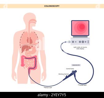 Illustration conceptuelle d'un procédé de coloscopie. Il s'agit d'un examen de l'intérieur de votre gros intestin, qui comprend le côlon, le rectum et l'anus. Il peut être utilisé pour explorer les causes possibles des douleurs abdominales, des saignements rectaux, des diarrhées chroniques et d'autres problèmes gastro-intestinaux. Il est également utilisé pour rechercher des signes possibles de cancer colorectal ou de polypes. Banque D'Images