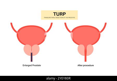 Illustration conceptuelle d'une résection transurétrale de la prostate (TURP). Il s’agit d’une intervention chirurgicale qui consiste à couper une section de la prostate. Il est généralement recommandé lorsque l'élargissement de la prostate provoque des symptômes gênants et ne répond pas au traitement avec des médicaments. Banque D'Images