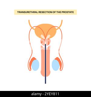 Illustration conceptuelle d'une résection transurétrale de la prostate (TURP). Il s’agit d’une intervention chirurgicale qui consiste à couper une section de la prostate. Il est généralement recommandé lorsque l'élargissement de la prostate provoque des symptômes gênants et ne répond pas au traitement avec des médicaments. Banque D'Images