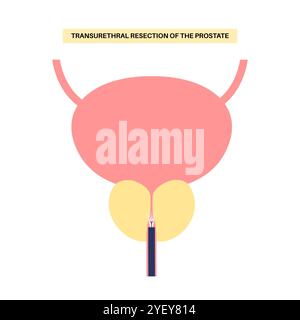 Illustration conceptuelle d'une résection transurétrale de la prostate (TURP). Il s’agit d’une intervention chirurgicale qui consiste à couper une section de la prostate. Il est généralement recommandé lorsque l'élargissement de la prostate provoque des symptômes gênants et ne répond pas au traitement avec des médicaments. Banque D'Images