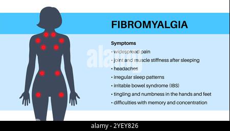 Illustration conceptuelle de la fibromyalgie. La fibromyalgie est une affection chronique qui cause de la douleur et de la sensibilité dans tout le corps, ainsi que de la fatigue et des troubles du sommeil. La cause exacte est inconnue, mais elle est souvent déclenchée par le stress physique ou psychologique. Banque D'Images