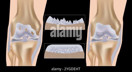 Arthrite du genou. Illustration vectorielle médicale avec structure de genou endommagée et comparaison de genou sain. Illustration de Vecteur