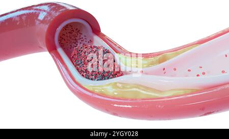 Illustration d'un vaisseau sanguin avec athérosclérose et caillot sanguin (thrombus). L'athérosclérose est un rétrécissement (sténose) d'une artère dû à des dépôts graisseux (jaunes) sur ses parois internes. Les dépôts sont constitués d'athérome, une substance comprenant du cholestérol, des cellules en décomposition, des cellules sanguines et des protéines grasses. Les dommages aux parois peuvent également provoquer la formation d'un thrombus, ce qui peut perturber la circulation sanguine. Un thrombus peut être fatal s’il bloque le flux sanguin vers un organe vital, comme le cerveau. Banque D'Images
