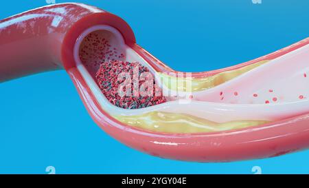Illustration d'un vaisseau sanguin avec athérosclérose et caillot sanguin (thrombus). L'athérosclérose est un rétrécissement (sténose) d'une artère dû à des dépôts graisseux (jaunes) sur ses parois internes. Les dépôts sont constitués d'athérome, une substance comprenant du cholestérol, des cellules en décomposition, des cellules sanguines et des protéines grasses. Les dommages aux parois peuvent également provoquer la formation d'un thrombus, ce qui peut perturber la circulation sanguine. Un thrombus peut être fatal s’il bloque le flux sanguin vers un organe vital, comme le cerveau. Banque D'Images