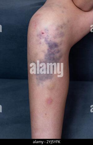 La femme montre une grosse ecchymose sur sa jambe résultant d'une blessure Banque D'Images