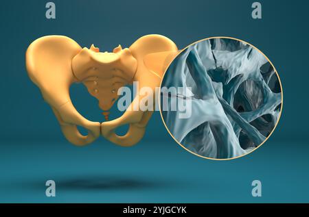 Fracture osseuse dans l'ostéoporose - vue isométrique illustration 3D. Banque D'Images