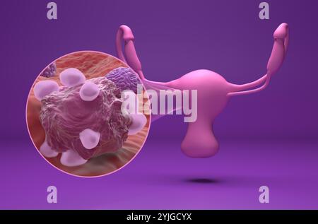 Cancer de l'ovaire - vue isométrique illustration 3D. Banque D'Images