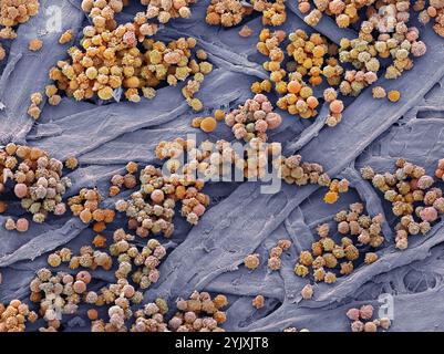 Leucémies sanguines. Micrographie électronique à balayage couleur (MEB) des globules blancs d'un patient atteint de leucémie lymphoïde chronique. Cette forme de cancer se trouve le plus souvent chez les personnes âgées et implique une augmentation des taux circulants de lymphocytes (un type de globules blancs), comme on le voit ici. Cela entraîne une réduction de la proportion de globules rouges, entraînant une anémie, ainsi que d’autres complications telles que l’hypertrophie du foie et de la rate. Grossissement : x1000 lors de l'impression à 10 centimètres de large. Banque D'Images