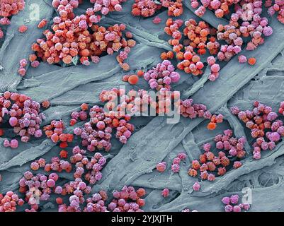 Leucémies sanguines. Micrographie électronique à balayage couleur (MEB) des globules blancs d'un patient atteint de leucémie lymphoïde chronique. Cette forme de cancer se trouve le plus souvent chez les personnes âgées et implique une augmentation des taux circulants de lymphocytes (un type de globules blancs), comme on le voit ici. Cela entraîne une réduction de la proportion de globules rouges, entraînant une anémie, ainsi que d’autres complications telles que l’hypertrophie du foie et de la rate. Grossissement : x1000 lors de l'impression à 10 centimètres de large. Banque D'Images