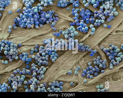 Leucémies sanguines. Micrographie électronique à balayage couleur (MEB) des globules blancs d'un patient atteint de leucémie lymphoïde chronique. Cette forme de cancer se trouve le plus souvent chez les personnes âgées et implique une augmentation des taux circulants de lymphocytes (un type de globules blancs), comme on le voit ici. Cela entraîne une réduction de la proportion de globules rouges, entraînant une anémie, ainsi que d’autres complications telles que l’hypertrophie du foie et de la rate. Grossissement : x1000 lors de l'impression à 10 centimètres de large. Banque D'Images