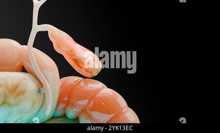 Calculs biliaires dans le canal biliaire, silhouette humaine et anatomie des organes environnants, foie et vésicule biliaire avec calculs, rendu réaliste 3D Banque D'Images