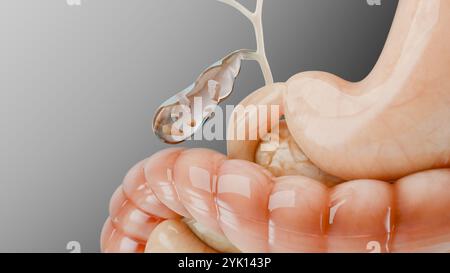 Calculs biliaires dans le canal biliaire, silhouette humaine et anatomie des organes environnants, foie et vésicule biliaire avec calculs, rendu réaliste 3D Banque D'Images