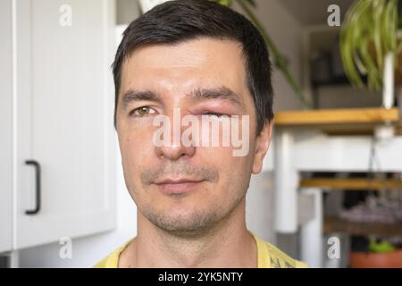 Une paupière rouge gonflée sur le visage d'un homme en gros plan est une allergie à une piqûre d'insecte. Réaction allergique aux insectes suceurs de sang Banque D'Images