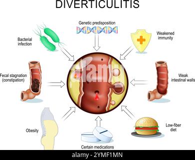 Déclencheurs de la progression des diverticulites. Péristaltisme gastro-intestinal et constipation chronique. Troubles de la motricité intestinale. Gros plan d'une partie d'un grand i. Illustration de Vecteur