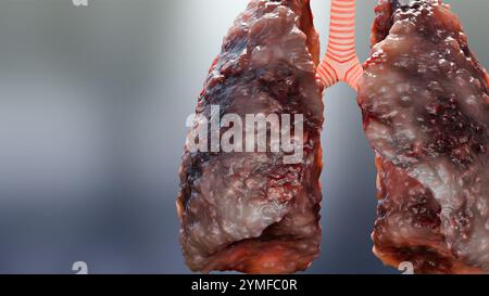 Pneumonie maladie, poumons sains et maladies poumons, cancer des poumons humains, fumeurs de cigarettes maladie pulmonaire, tumeur maligne cancéreuse en croissance et propagation Banque D'Images
