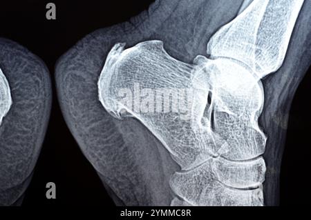 Une radiographie simple du pied de la patiente montre l'éperon calcanéen du talon, des formes osseuses d'excroissance sur l'os du talon, une fasciite plantaire, une inflammation de la fibre Banque D'Images