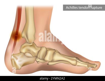 Rupture et traumatisme du tendon d'Achille Illustration de Vecteur