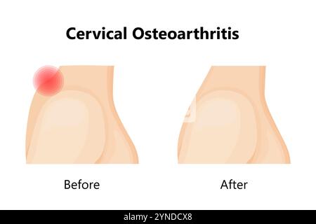 Soins médicaux de l'ostéochondrose cervicale, avant et après. Illustration de Vecteur